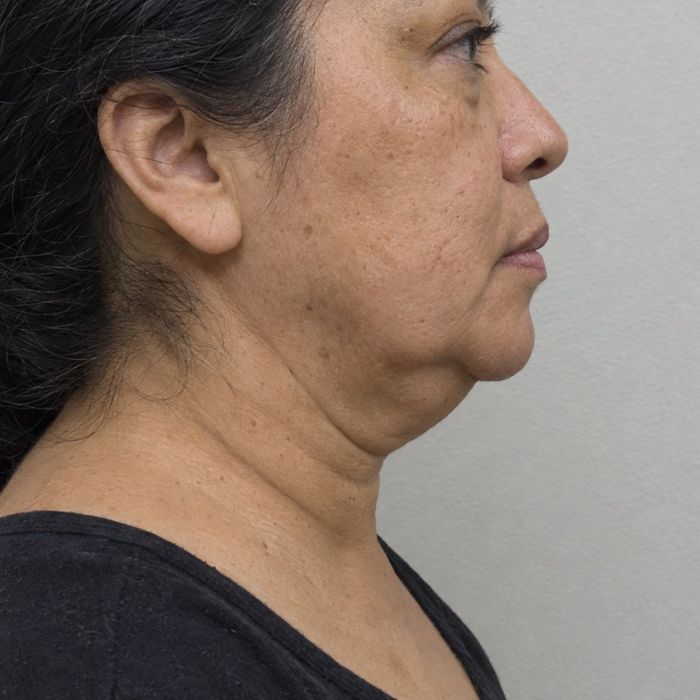 Mandíbula caída y papada